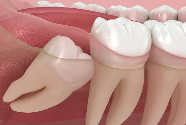 Exodontia de Dentes do Siso