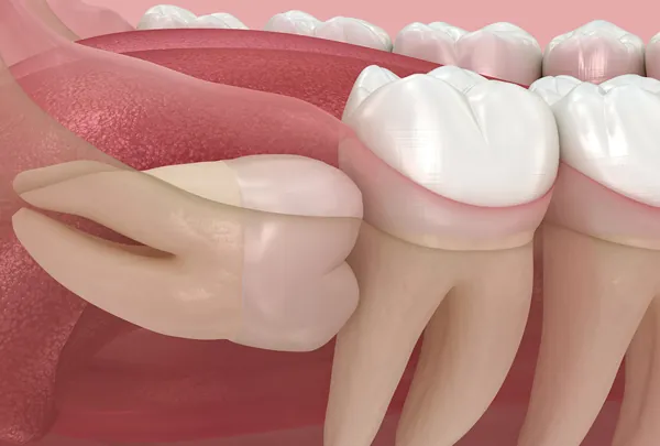 Exodontia de Dentes do Siso
